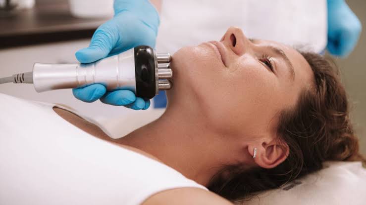 Radiofrecuencia facial